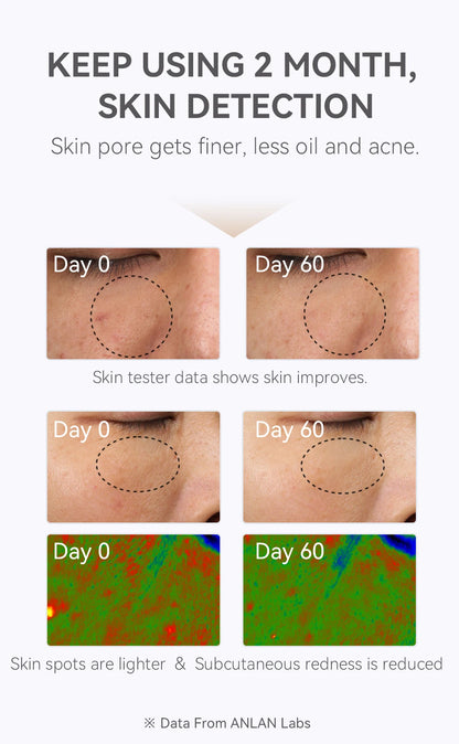 ANLAN LED Gesichtsmaske – 5 Farben für strahlend schöne Haut ✨